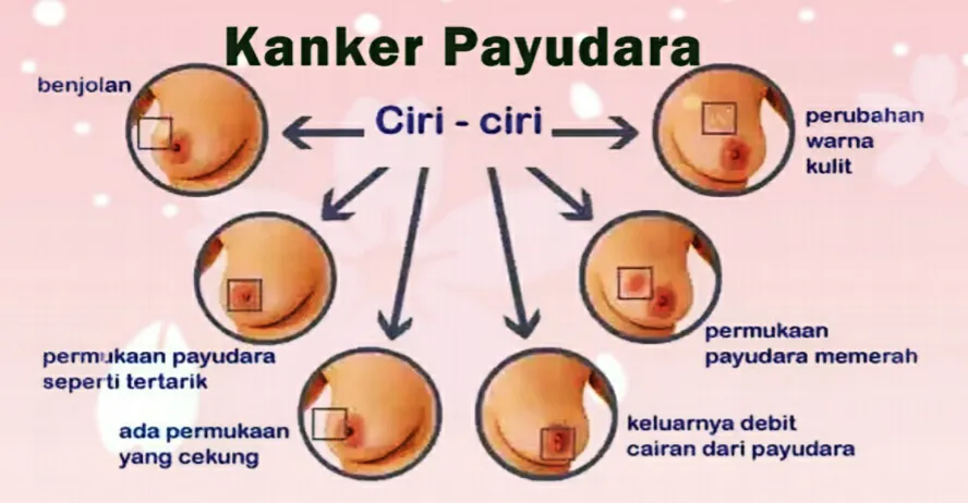 Cegah Kanker Payudara image 1